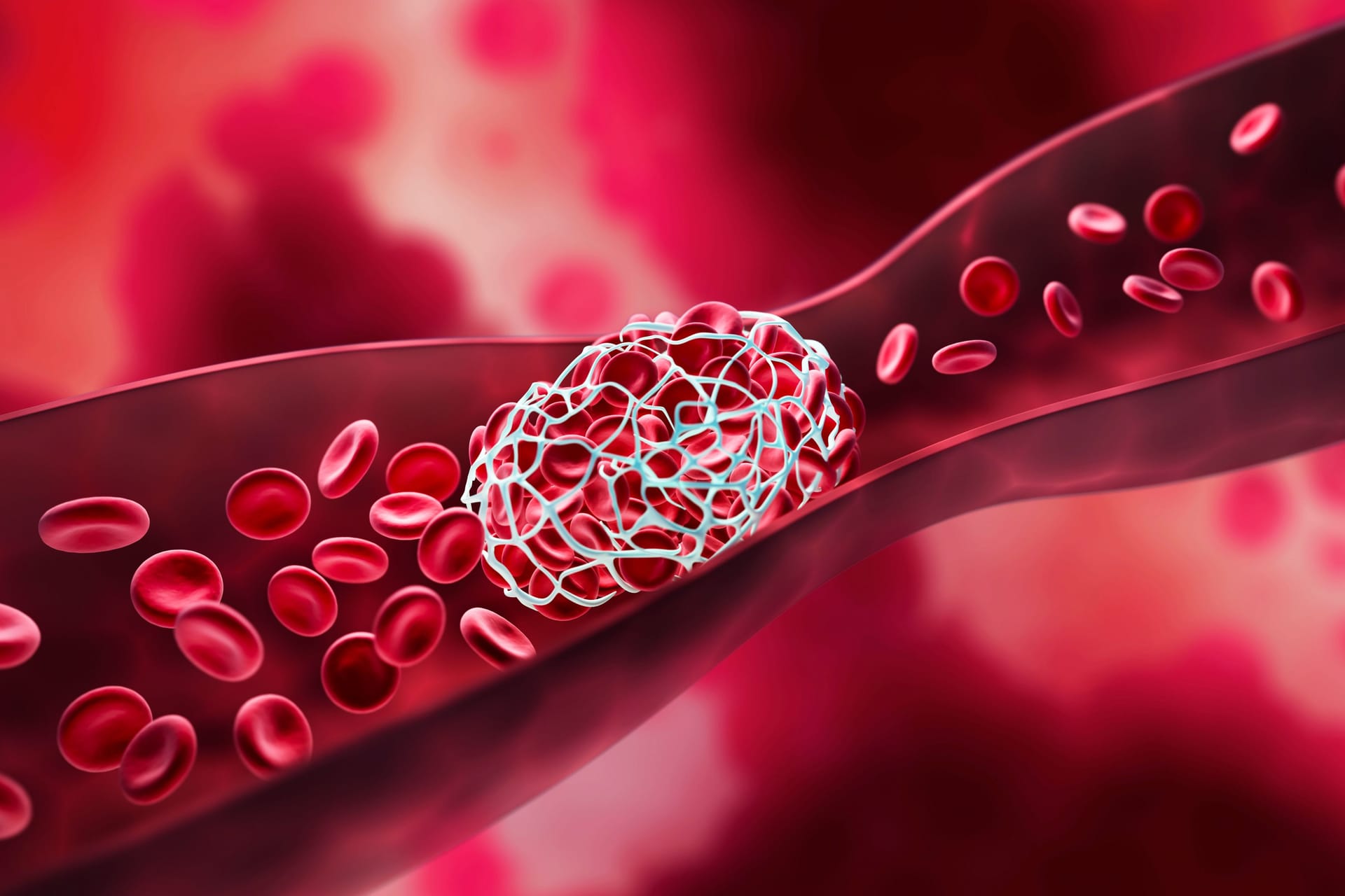 Thrombose: Blutgerinnsel können die Gefäße verstopfen und die Blutzufuhr in wichtige Organe unterbrechen. Thrombose: Blutgerinnsel können die Gefäße verstopfen und die Blutzufuhr in wichtige Organe unterbrechen.